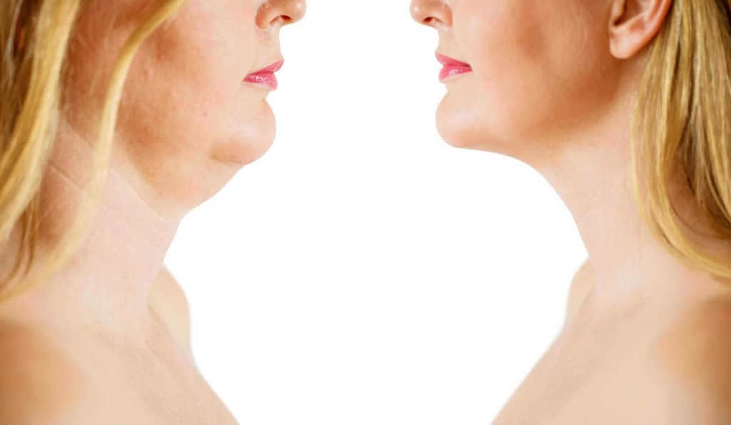 Double Chin treatment Wembley Park before and after results