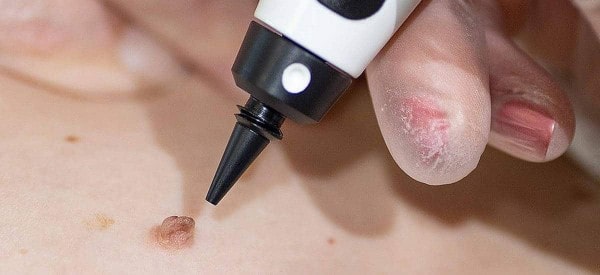After Skin Tag Removal Wembley Park