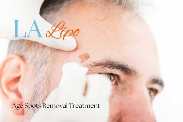 What Are the Most Effective Treatments for Age Spots Wembley Park?