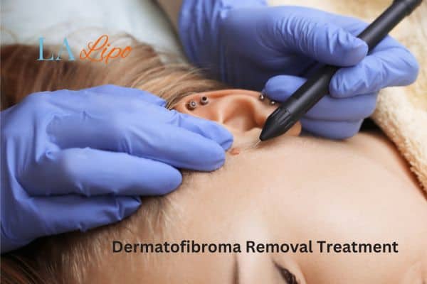 Dermatofibroma Removal Treatment Wembley Park