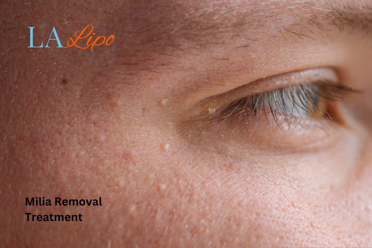 Cryopen Milia Removal: Is It the Easiest and Safest Option Wembley Park?
