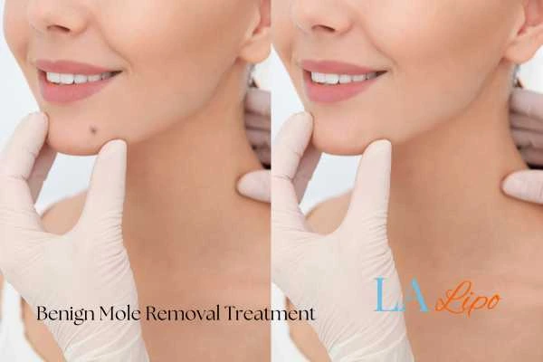 Before-and-after results following benign mole-removal treatment Wembley Park