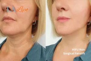 hi-fu for wrinkles Wembley Park before and after results