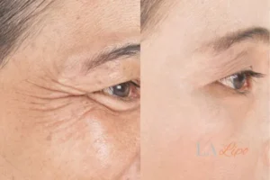 Before and after results of woman - HI-fu wrinkles reduction treatment Wembley Park