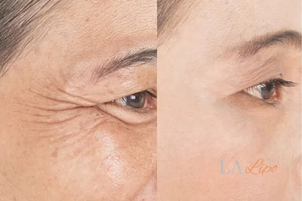 Before and after results of woman - HI-fu wrinkles reduction treatment Wembley Park