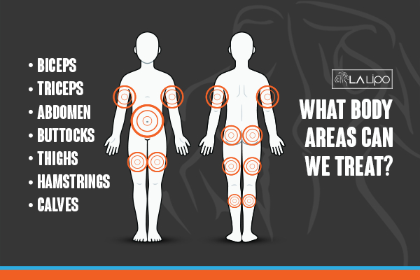 Graphic to show areas you can have LA-EMS Body Sculpting Wembley Park treatment.