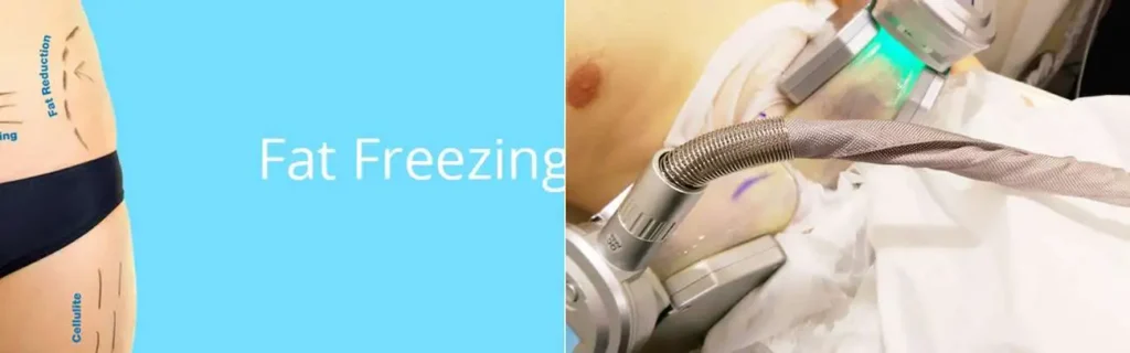 Fat freezing Wembley Park on multiple areas of the body