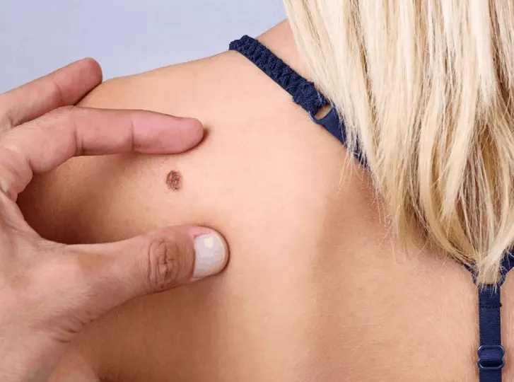 woman having mole removal Wembley Park consultation before treatment.