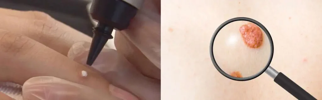 Cryopen for mole removal Wembley Park - speak to our team today!