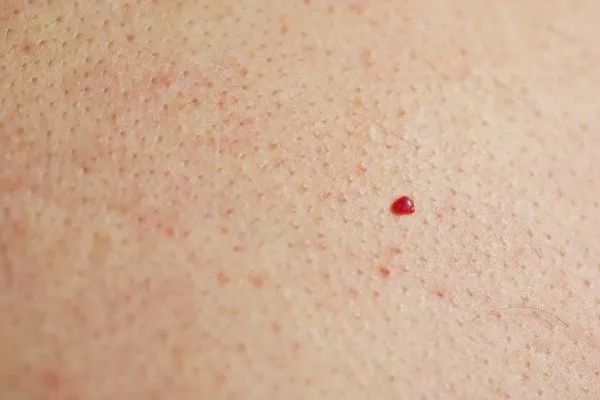 close up of a cherry angioma Wembley Park