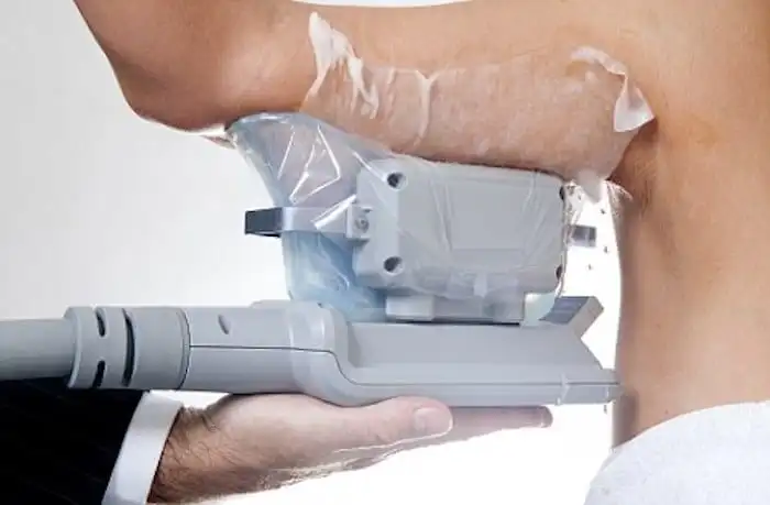 Picture of fat freezing Wembley Park on the upper arms.