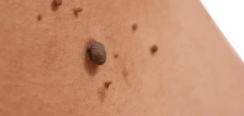 image of a skin tag Wembley Park