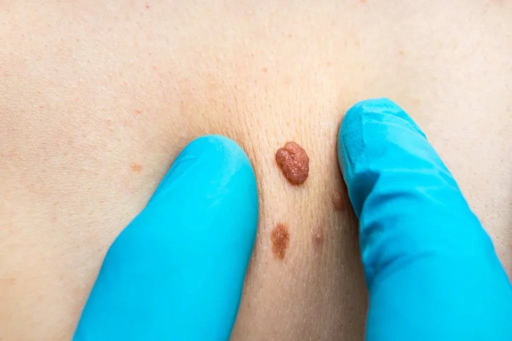Consultant examining a skin tag Wembley Park