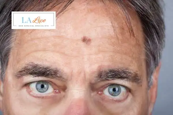 Solar Lentigo Removal Wembley Park image of man with mark on his forehead