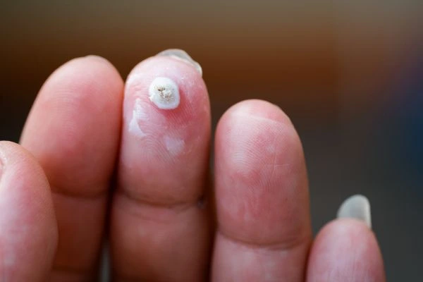 wart on person finger - cryotherapy to treat from LA LIPO Wembley Park