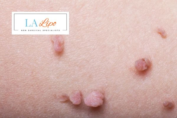Does cryopen skin tag removal Wembley Park hurt? Find out now call our team today!