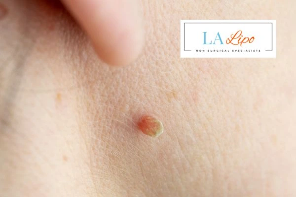 Book skin tag removal Wembley Park today speak to our team now!