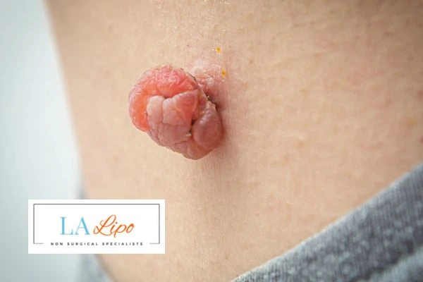 Interested in skin tag removal Wembley Park? Concerned about the pain? Find out more today!