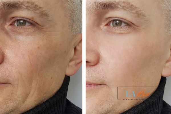 See the amazing results of Morpheus8 Treatment Wembley Park!