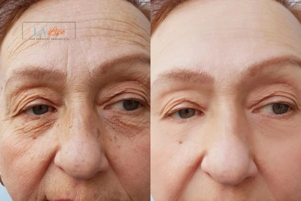 The powerful benefits of Morpheus8 Treatment Wembley Park - Call Our team today!