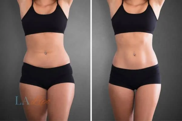 before and after results of non-surgical treatment to help a woman's body image and mental health Wembley Park