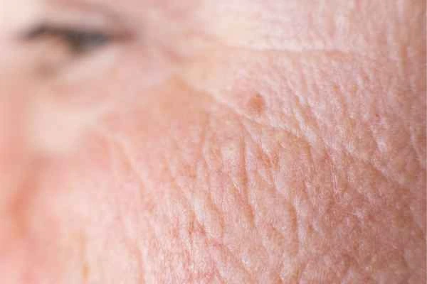 close up picture of a woman's face showing an age spot Wembley Park