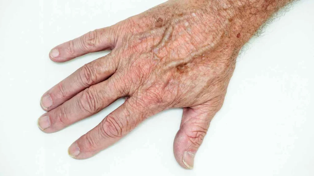 Male hand showing age spot Wembley Park