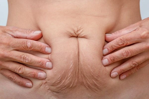 Should I Combine Diastasis Recti Treatment with Body Contouring for Better Results Wembley Park?