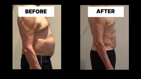 What Symptoms Can Diastasis Recti Cause in Men? Weak Core, Back Pain and Poor Posture Wembley Park